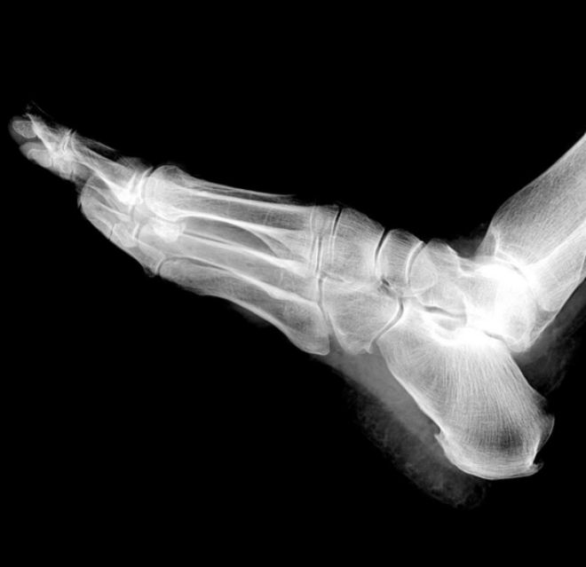 Plantar Fasciitis- Evidence Based Physiotherapy Management